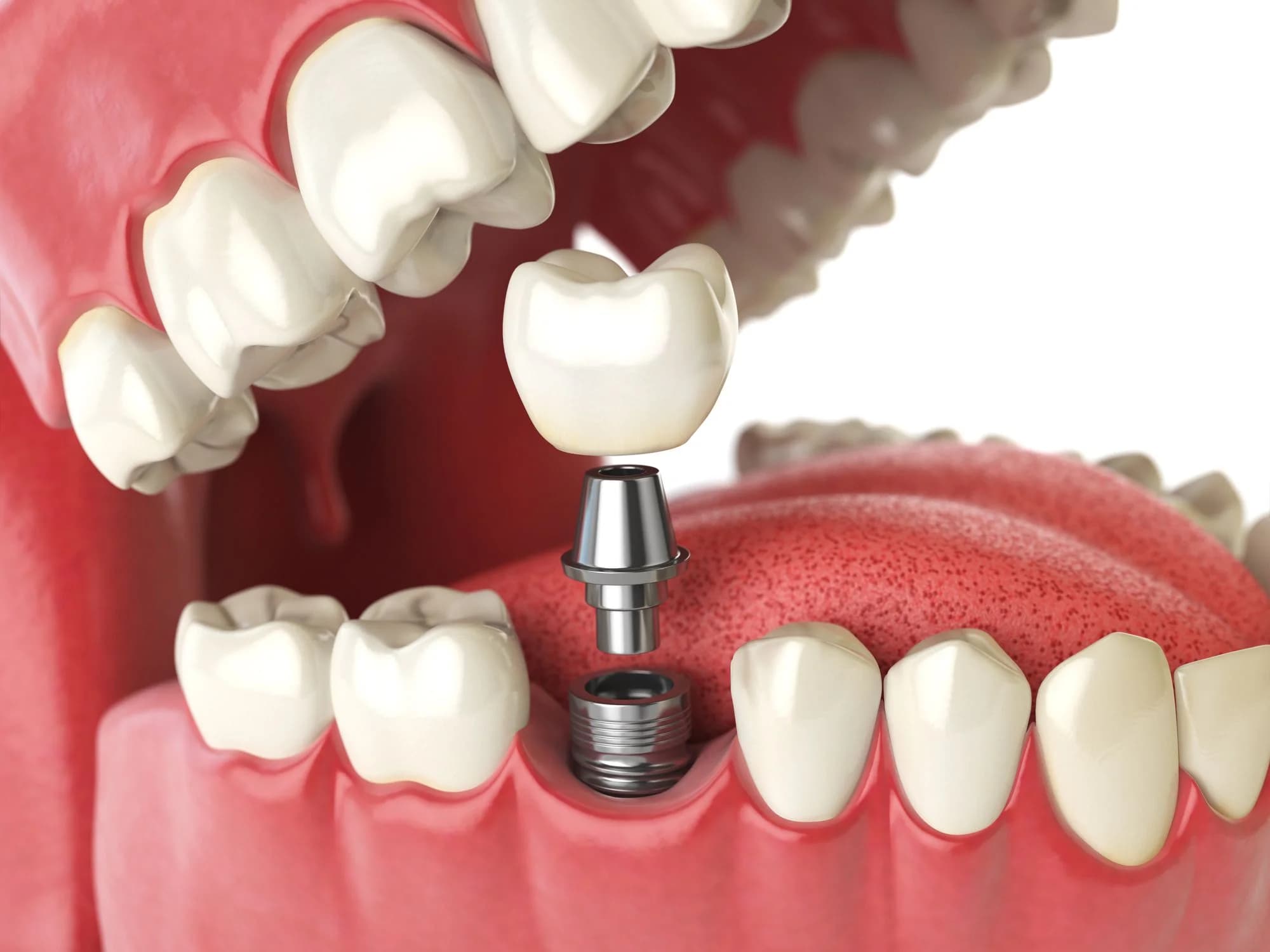 Transform Your Smile with Dental Implants