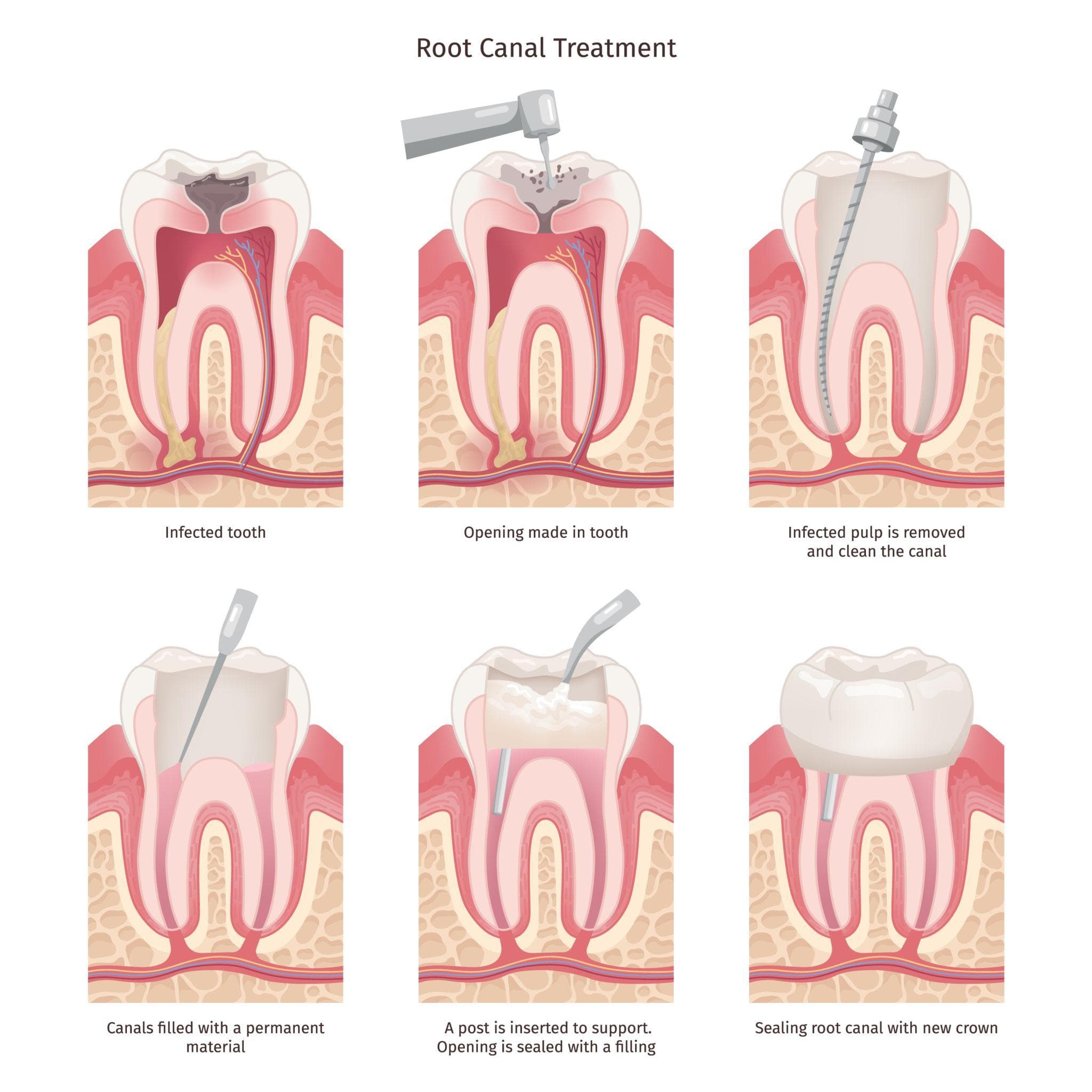 Root Canal Treatment