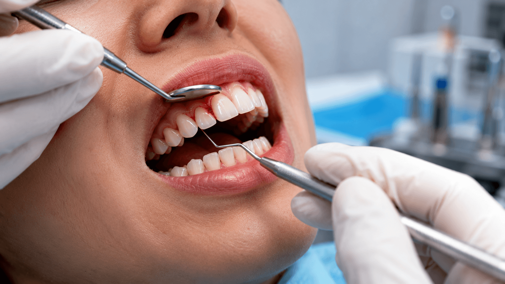 Bleeding Gums: When Do You Need a Tooth Crown?