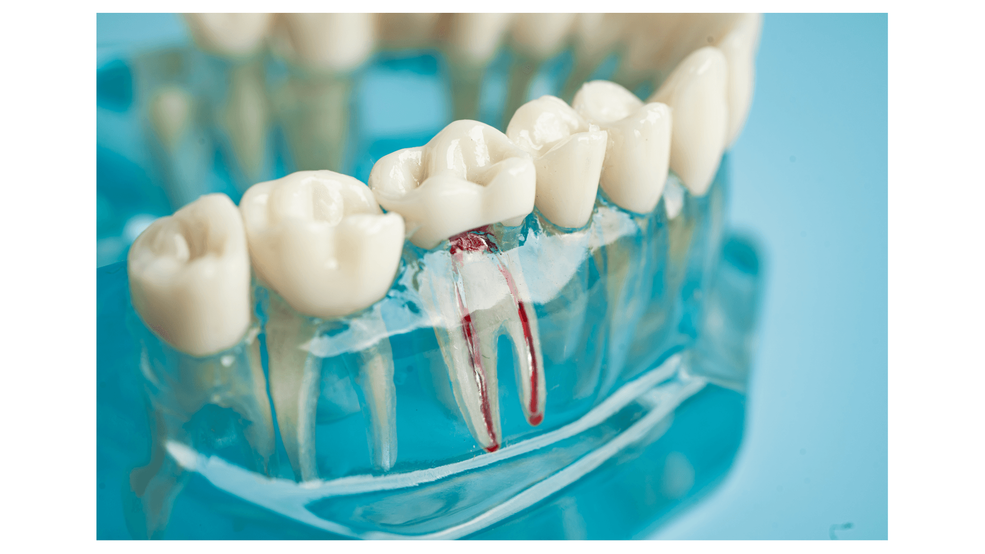 Root Canal Treatment in Secunderabad