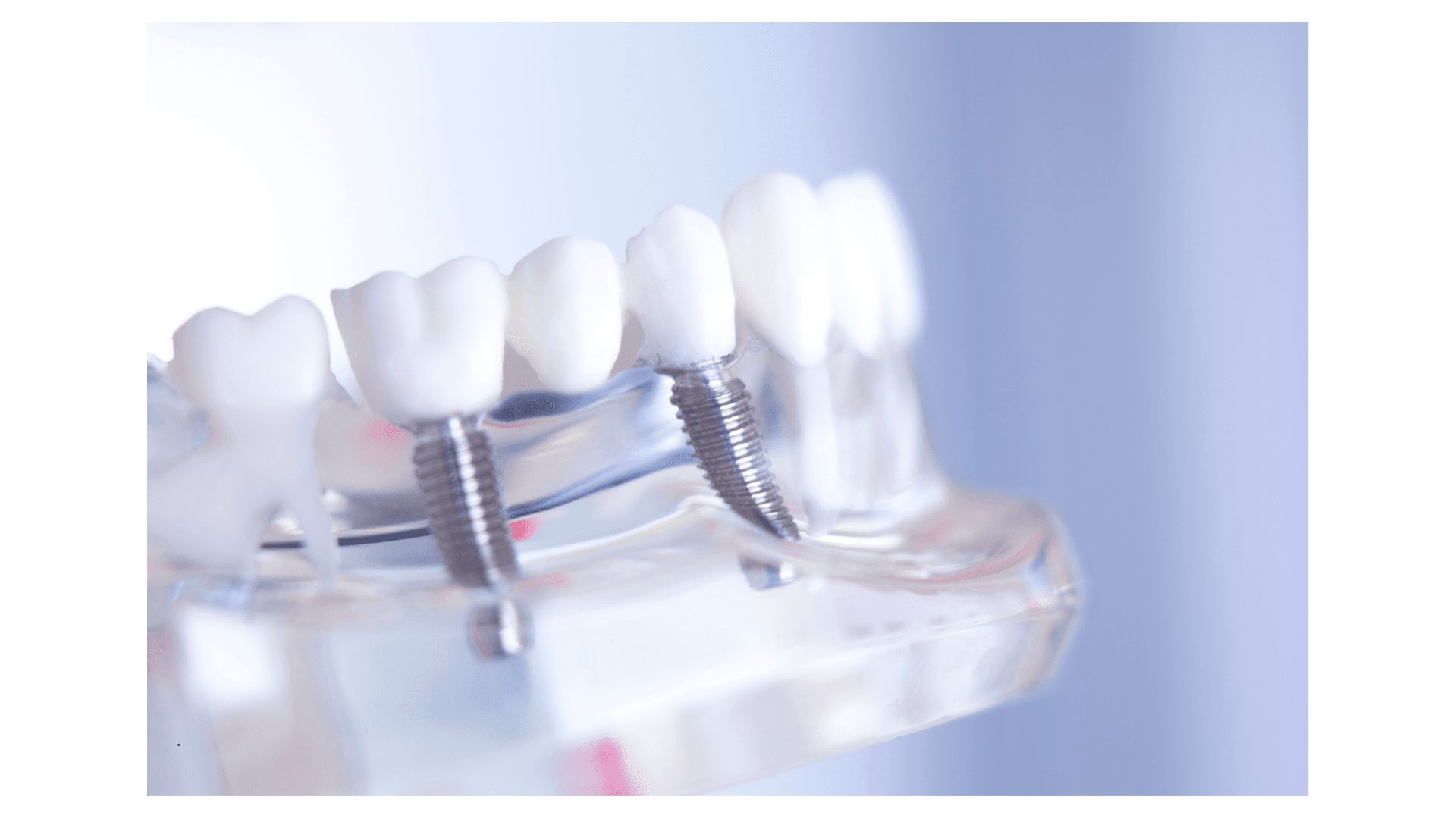 Dental Implants in Secunderabad