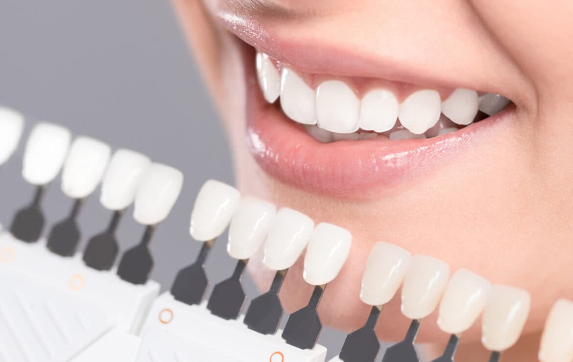Dental Veneers in AS Rao Nagar