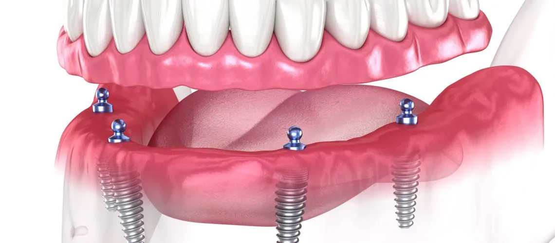 Dental Implants in Secunderabad – KJS Dental Hospital